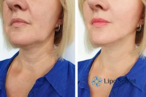 Double chin before and after Hi-Fu treatment 4 Book your double chin treatment Dartford today! We are here to help!
