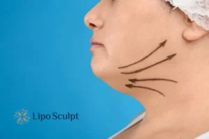 Double chin before and after Hi-Fu treatment 3 Boost your confidence with a Double chin treatment Dartford