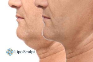 Double chin before and after Hi-Fu treatment 2 Double chin treatment Dartford from Lipo Sculpt - feel more confident today!