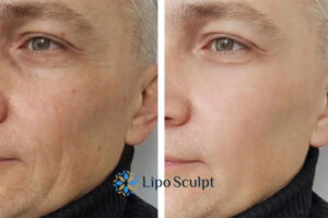 How to Fight Aging Symptoms 3 Fight Aging Symptoms Dartford With HIFU and Morpheus8 Today!