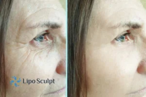 How to Fight Aging Symptoms 2 Do you want to Fight Aging Symptoms Dartford? Contact Lipo Sculpt today!