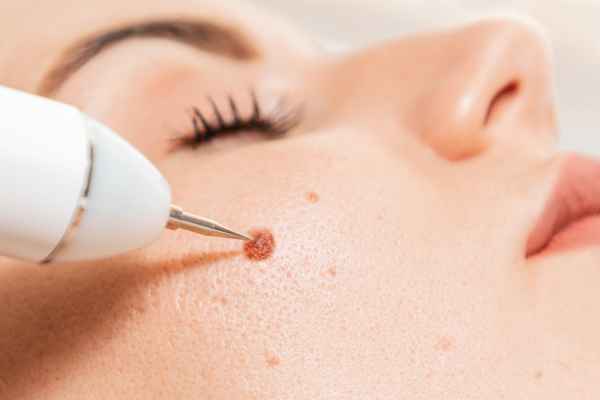 CryoPen: 5 Skin Concerns It May Be Used to Treat 3 What actually happens during a CryoPen treatment Dartford?