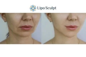 Explaining Total Skin Tightening Treatment And What It Can Do For You 2 Do you want to boost your self confidence? Give Morpheus8 Dartford a try today!