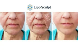 Explaining Total Skin Tightening Treatment And What It Can Do For You 3 Boost your confidence with Morpheus8 Dartford call our team today!