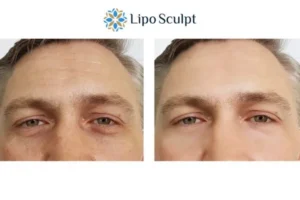 Explaining Total Skin Tightening Treatment And What It Can Do For You 6 Morpheus8 Dartford book in today to find out more!