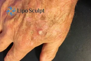 Best Actinic Keratoses Removal 2 Improve your wellbeing and health with Actinic Keratoses Dartford removal.treatment