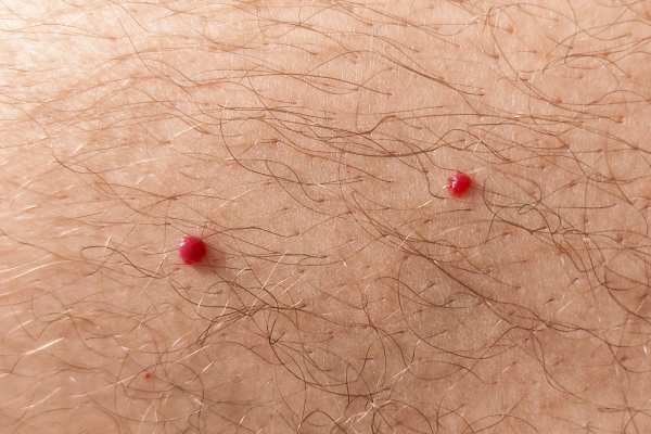CryoPen: 5 Skin Concerns It May Be Used to Treat 2 cherry angioma removal Dartford