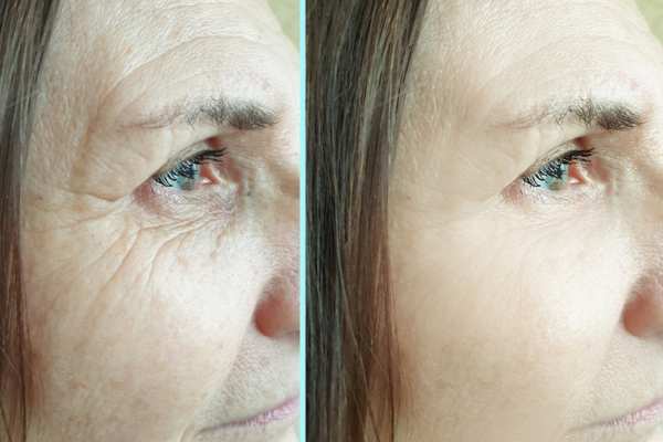 Why Do People Choose HIFU for a Non-Surgical Facelift? 4 How long can HIFU results last Dartford?