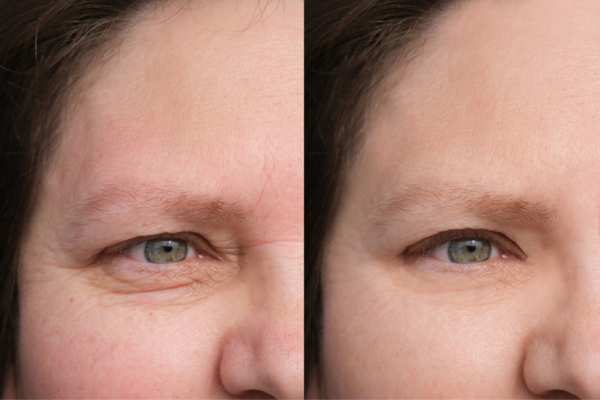 HIFU vs Botulinum Toxin: Understanding the Differences 4 How long do HIFU results last Dartford?