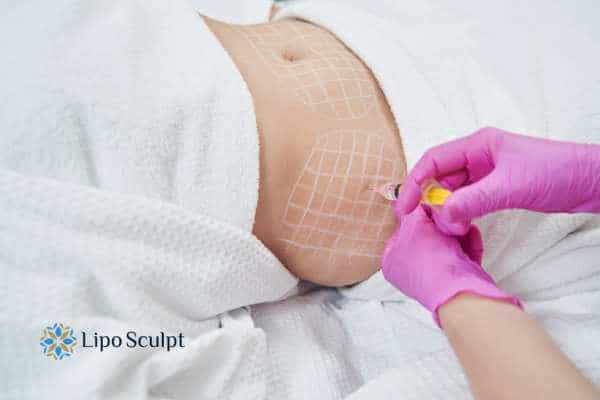 aqualyx fat injections