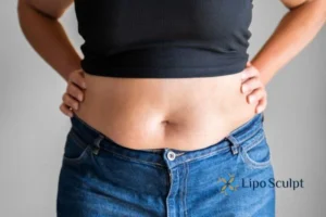 Bidding Farewell to Muffin Tops with Aqualyx Fat Injections 2 Do you wish you could reduce your muffin top Dartford With Aqualy fat dissolving injections you can!