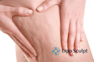 CoolSculpting for Legs: The Innovative Approach to Redefining Your Legs 5 Start your journey today book your coolsculpting treatment Dartford online today!