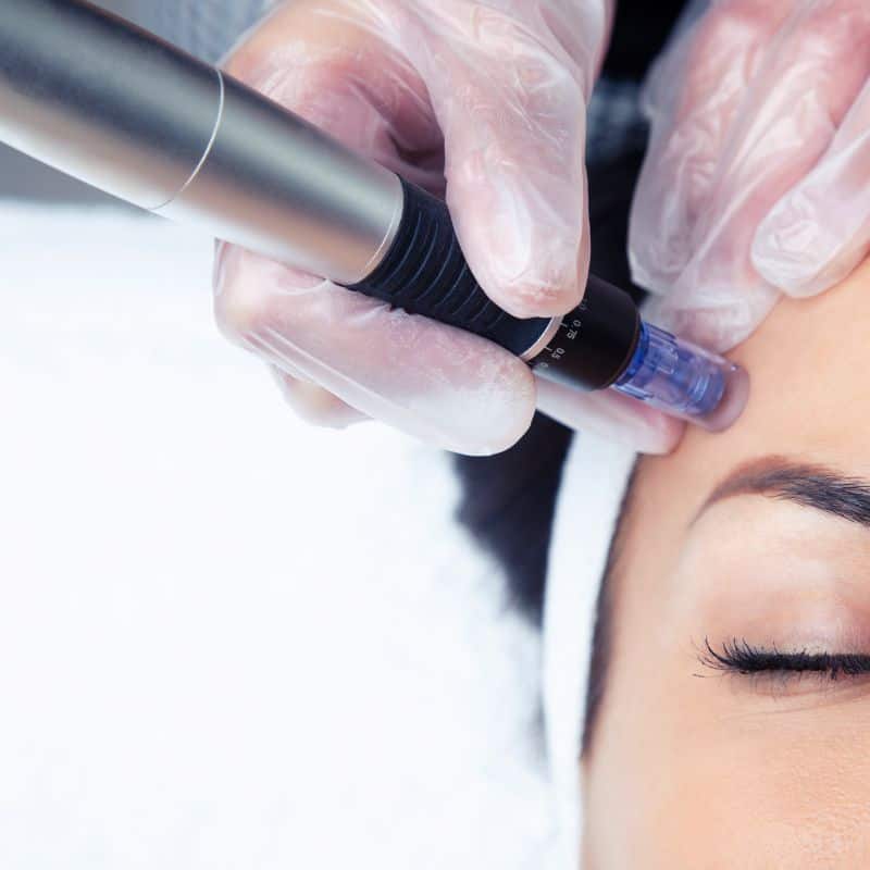 Morpheus8 treatment Dartford from Lipo Sculpt - Book in today!