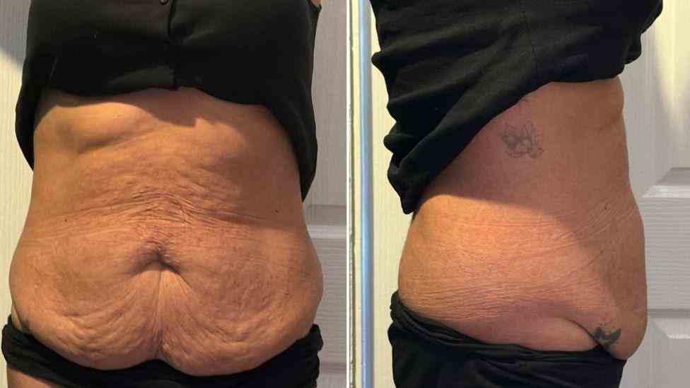 Lost the Weight but Not the Loose Skin? What You Should Know 1 Is It Definitely Loose Skin Dartford?