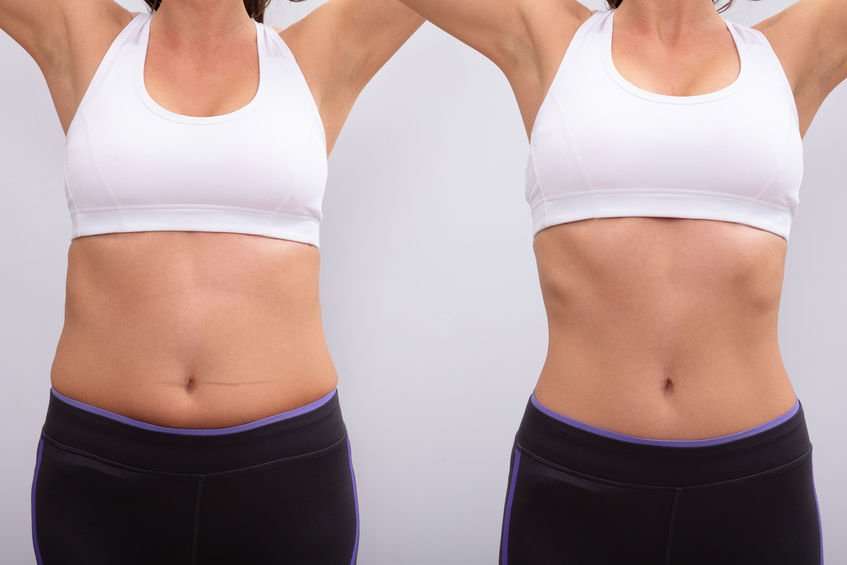 aqualyx injection before and after